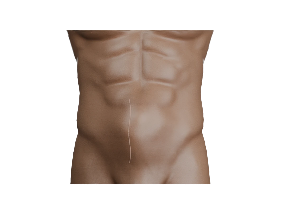 Vista exterior del abdomen con una hernia incisional, antes de su preparación